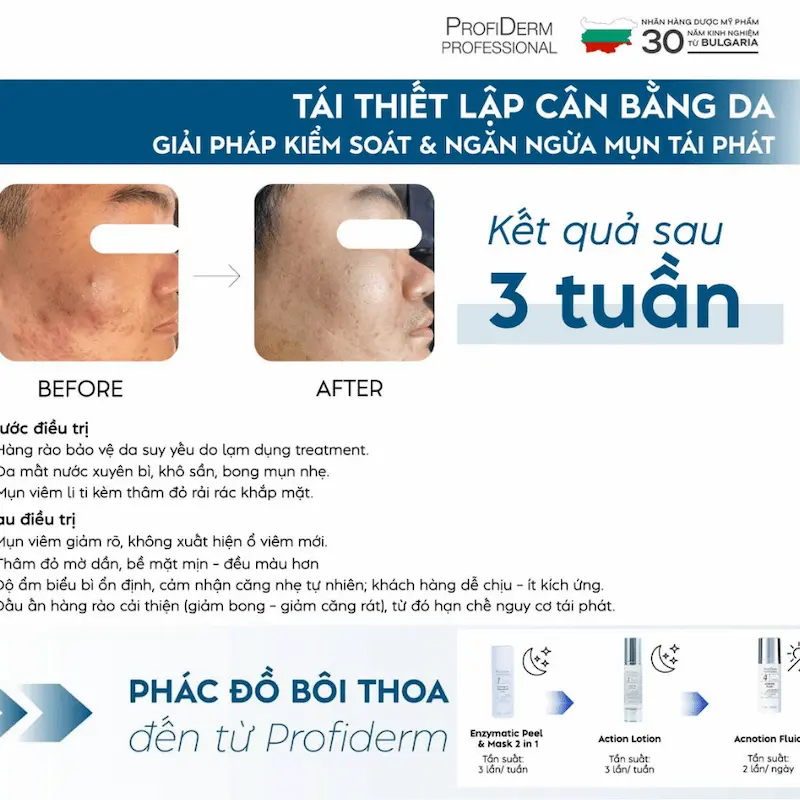 Gợi ý sản phẩm trị mụn hiệu quả từ Profiderm