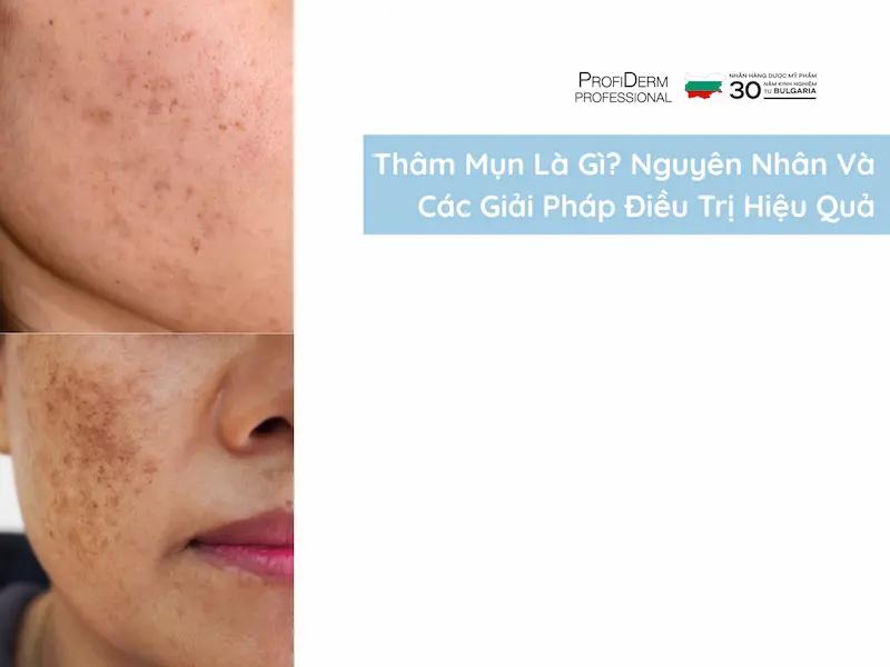 Thâm Mụn Là Gì? Nguyên Nhân Và Các Giải Pháp Điều Trị Hiệu Quả