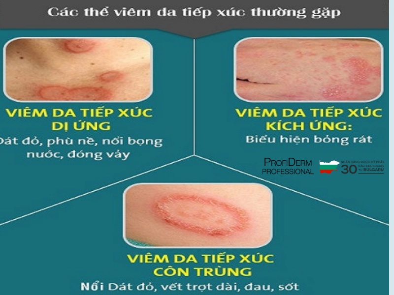 da nhạy cảm bị ửng đỏ da nhạy cảm bị ửng đỏ