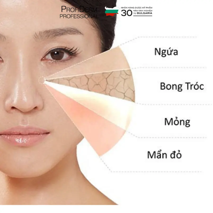 phục hồi da mụn