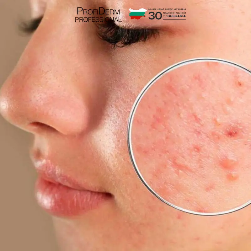 chăm sóc da mặt bị hư tổn