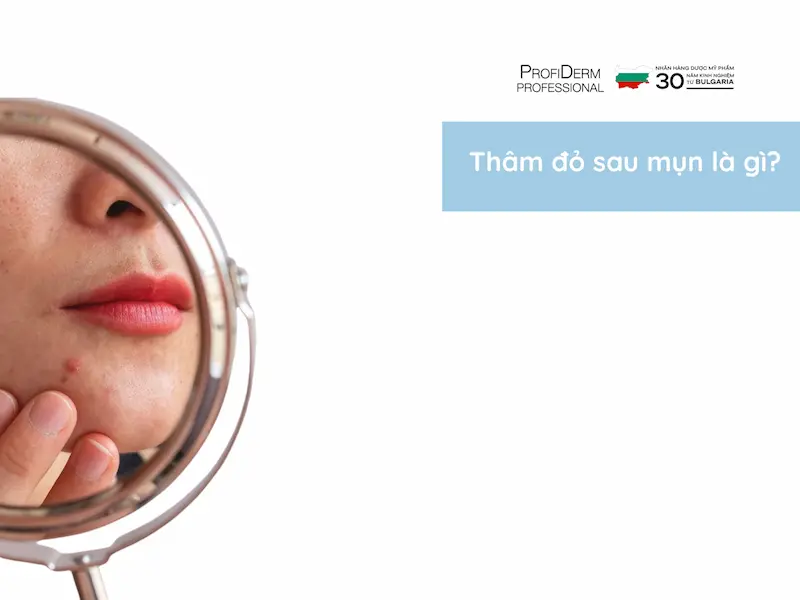 Thâm Đỏ Sau Mụn: Nguyên Nhân, Cách Điều Trị Nhanh Chóng và Hiệu Quả