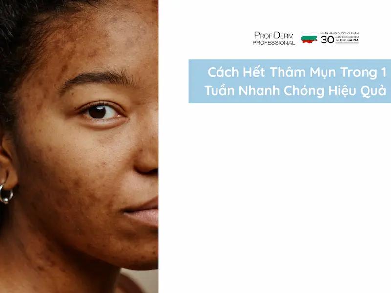 Cách Hết Thâm Mụn Trong 1 Tuần Nhanh Chóng Hiệu Quả
