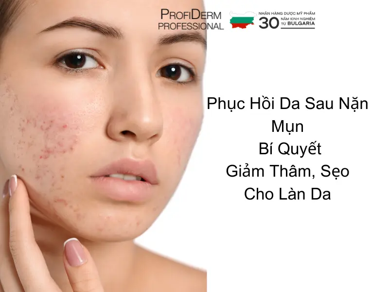 phục hồi da sau nặn mụn