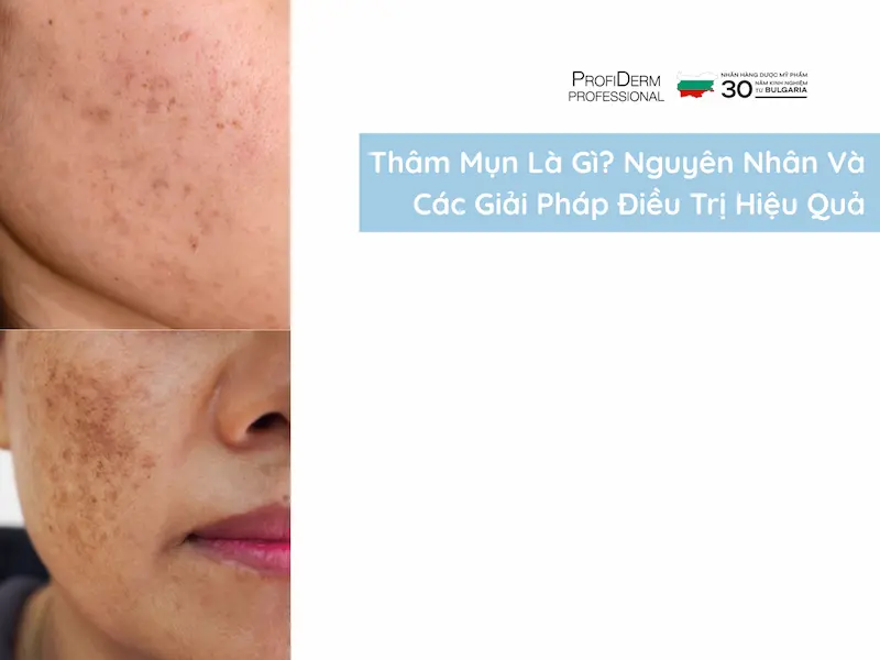 thâm mụn