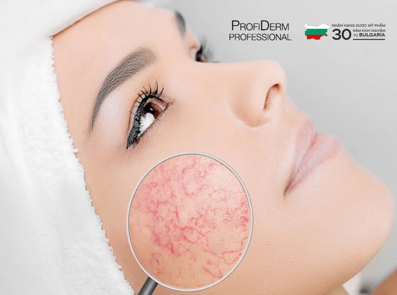 giãn mao mạch có tự khỏi không