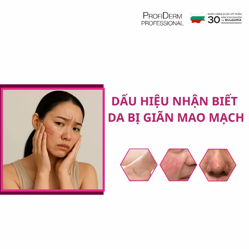 giãn mao mạch có tự khỏi không