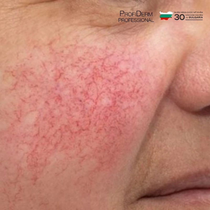 giãn mao mạch có tự khỏi không