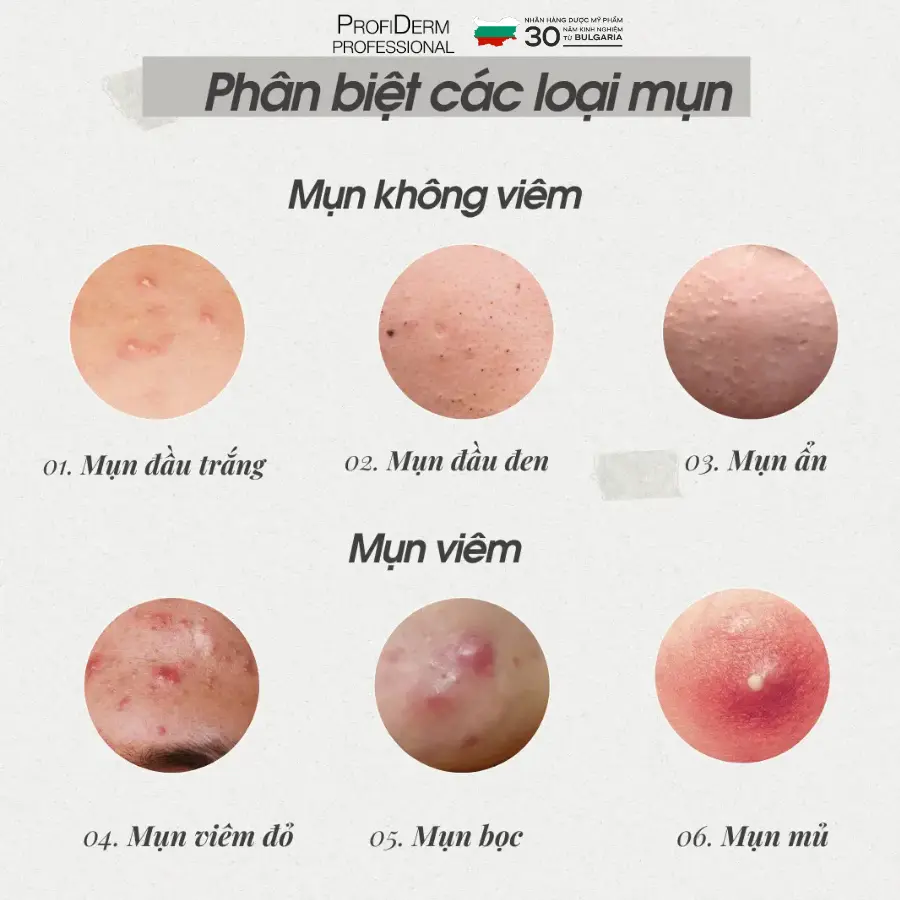 các loại thâm mụn