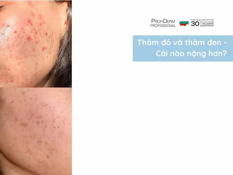 thâm đỏ và thâm đen cái nào nặng hơn