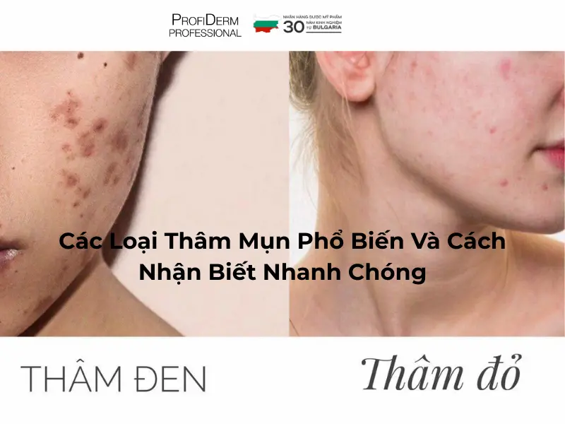 các loại thâm mụn