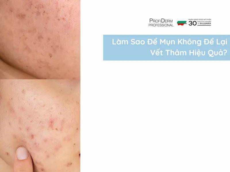 #Làm Sao Để Mụn Không Để Lại Vết Thâm Hiệu Quả?