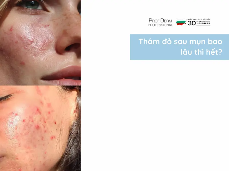 thâm đỏ sau mụn bao lâu thì hết