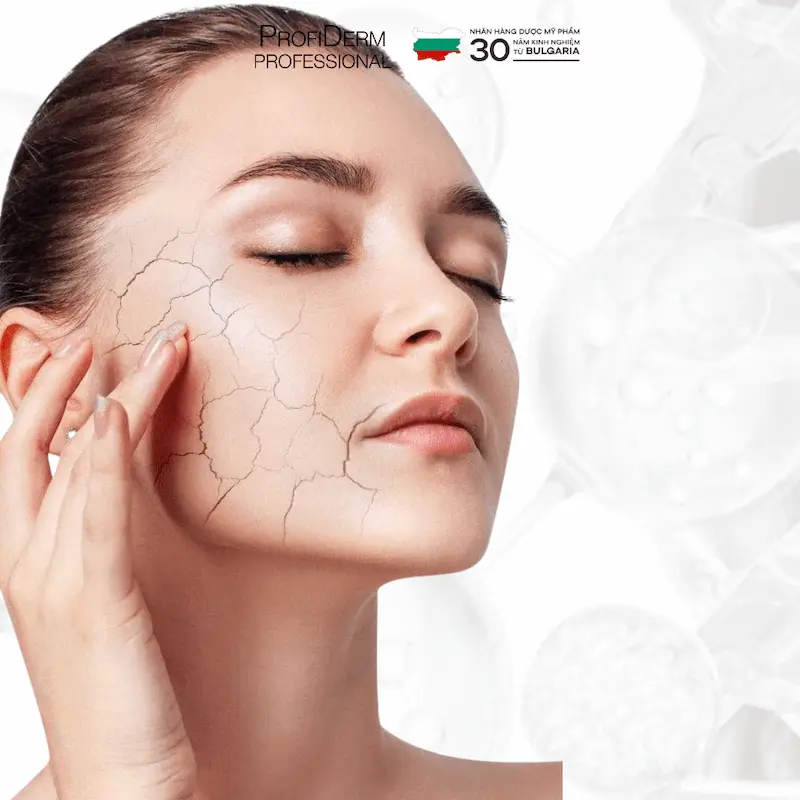 Các vị trí da dễ bị giãn mao mạch