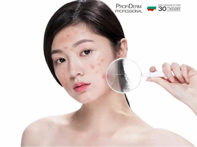 các hoạt chất trị thâm đỏ