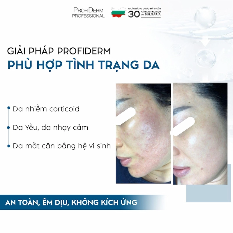 Profiderm Việt Nam – Địa chỉ phân phối Azexo Pure Gel uy tín