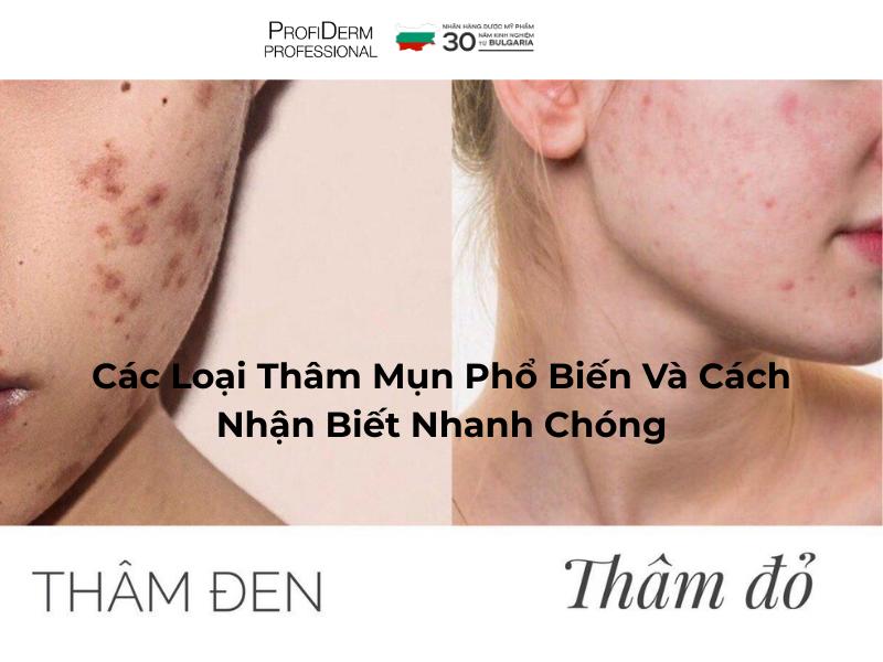Các Loại Thâm Mụn Phổ Biến Và Cách Nhận Biết Nhanh Chóng