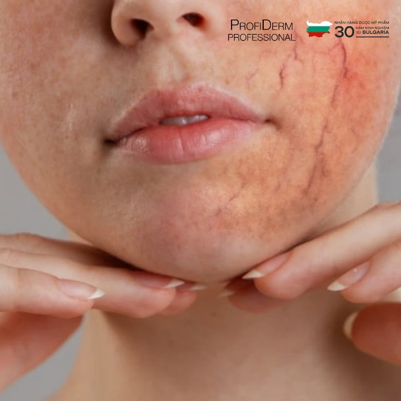 Giãn mao mạch có lan rộng không