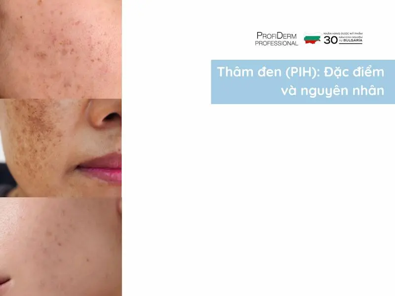 thâm đỏ và thâm đen cái nào nặng hơn