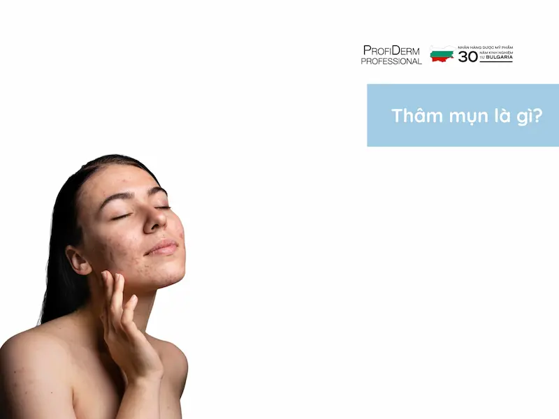 thâm đỏ sau mụn bao lâu thì hết