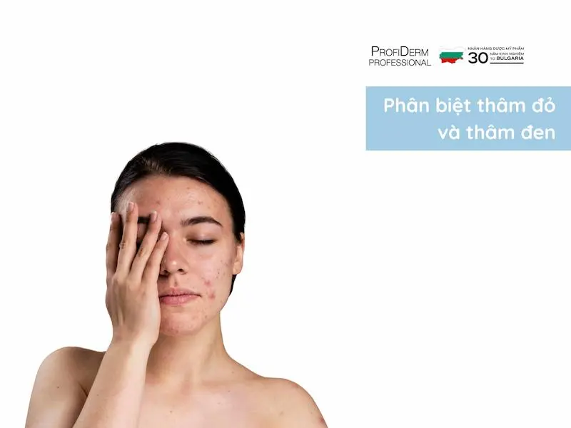 Phân biệt thâm đỏ và thâm đen: bảng so sánh nhanh