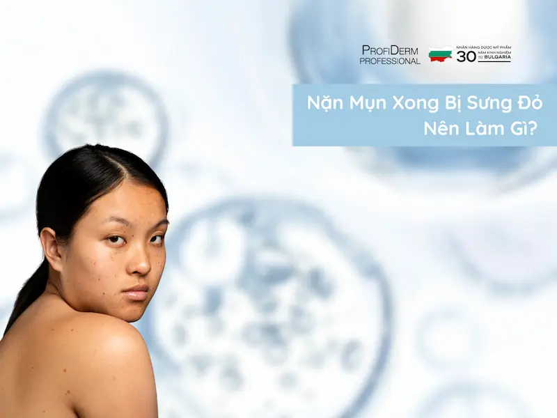 nặn mụn xong bị sưng đỏ nên làm gì
