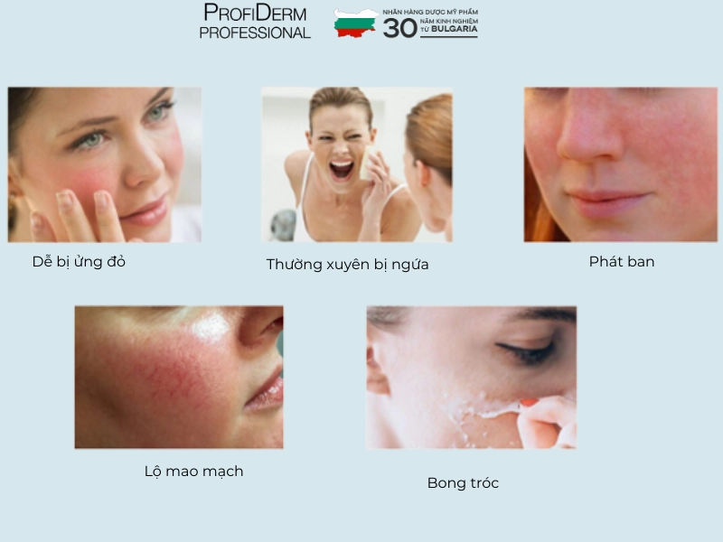 dấu hiệu nhận biết da nhạy cảm