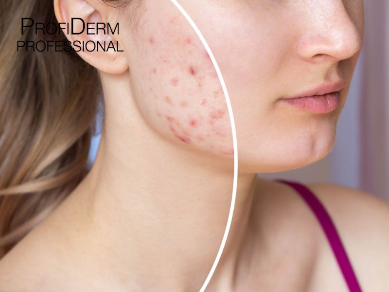 Vết Thâm Mụn Mãi Không Hết Phải Làm Sao? Cách Trị Hiệu Quả
