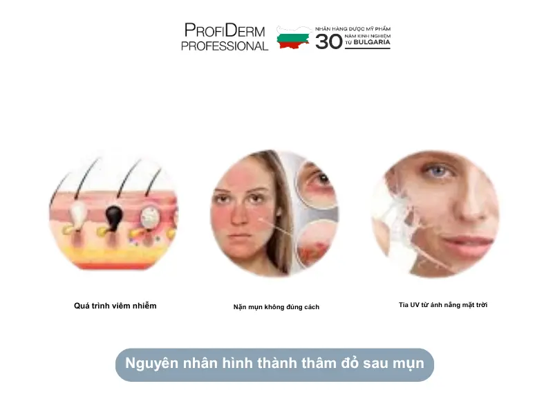 Nguyên nhân hình thành thâm đỏ sau mụn Nguyên nhân hình thành thâm đỏ sau mụn