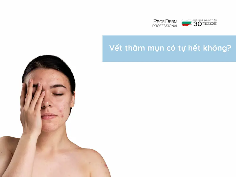 Vết thâm mụn có tự hết không?
