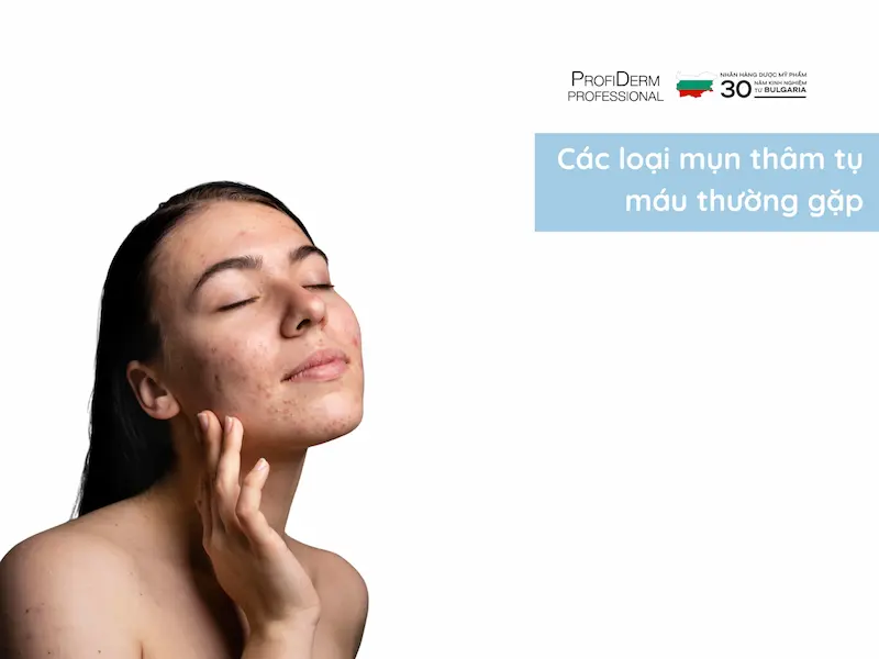 mụn thâm tụ máu