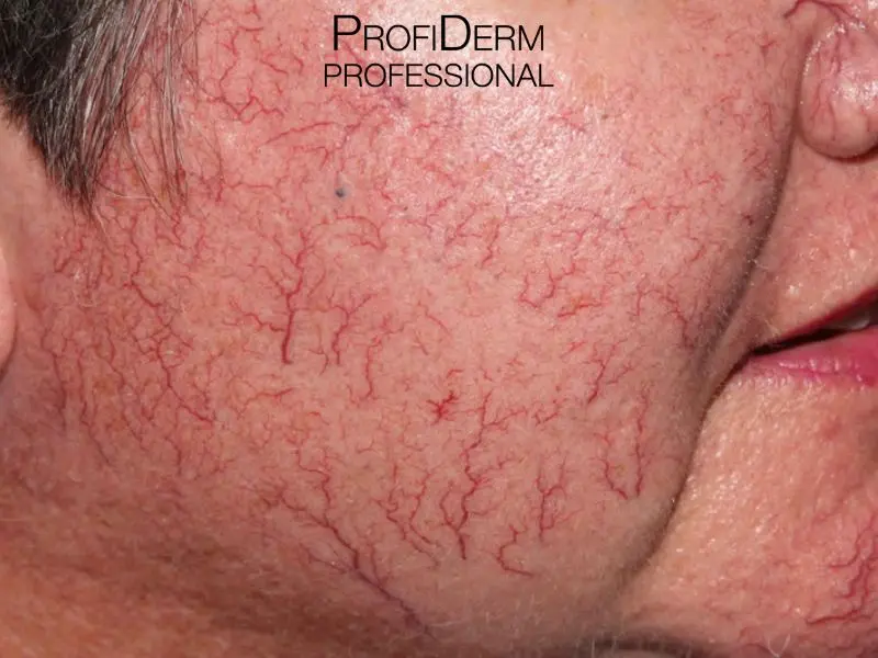 trị da mặt mỏng nổi gân máu tại nhà