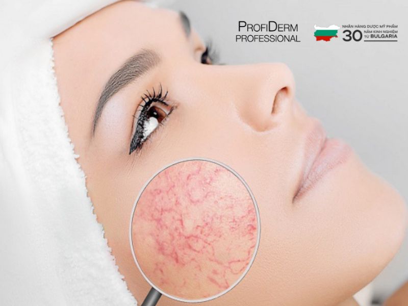 #Giãn Mao Mạch Có Tự Khỏi Không? Có Lan Rộng Không?