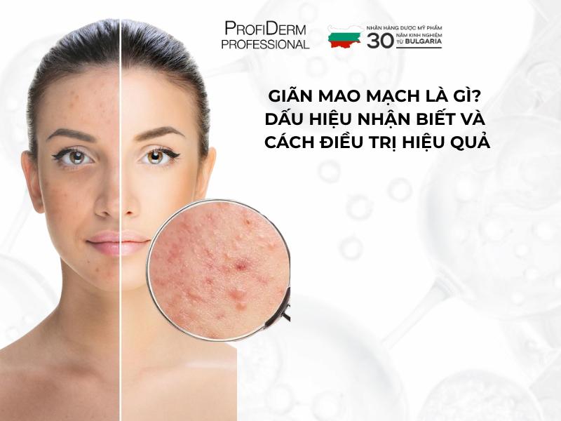 #Giãn Mao Mạch Là Gì? Dấu Hiệu Nhận Biết & Cách Điều Trị
