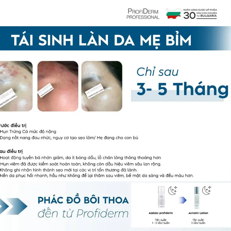 Tại sao nên chọn sản phẩm tẩy tế bào chết hóa học từ Profiderm Việt Nam?