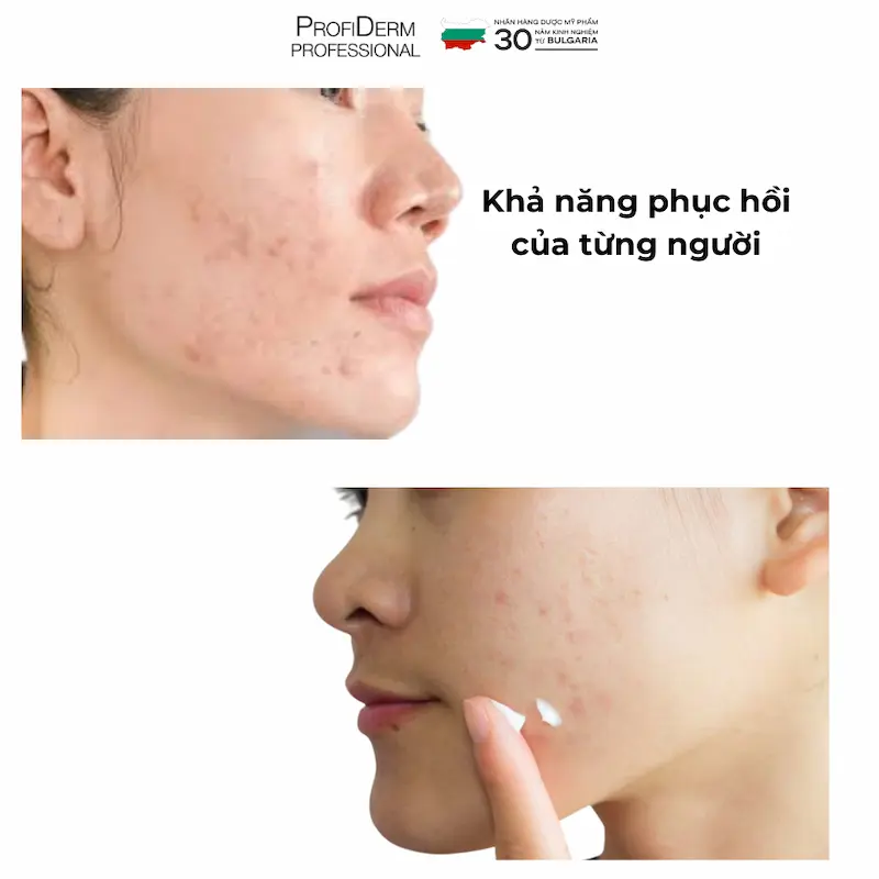 vết thâm mụn có tự hết không