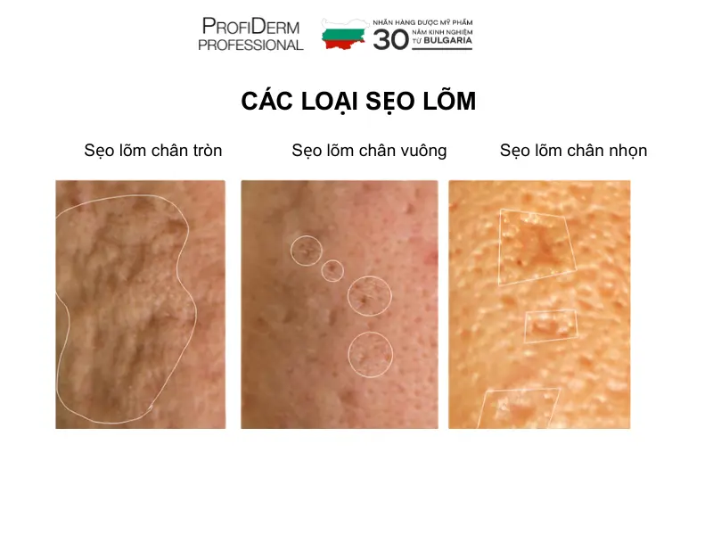 phục hồi da sau nặn mụn
