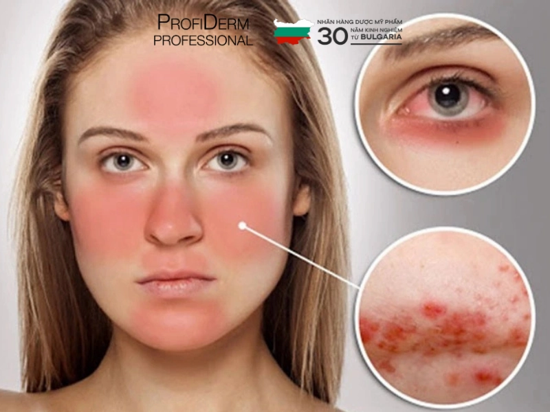 dấu hiệu nhận biết da nhạy cảm