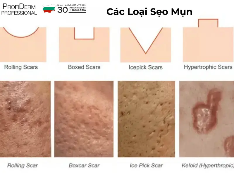 các loại thâm mụn