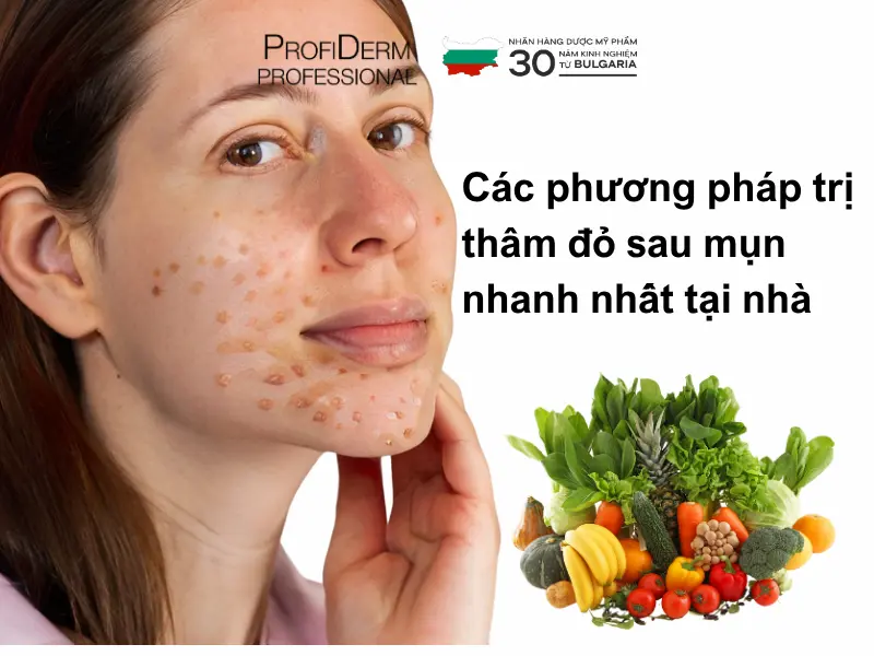 Phương pháp trị thâm đỏ sau mụn nhanh nhất tại nhà Phương pháp trị thâm đỏ sau mụn nhanh nhất tại nhà