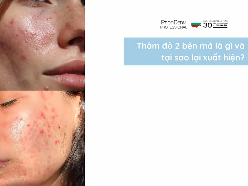 cách trị thâm đỏ 2 bên má