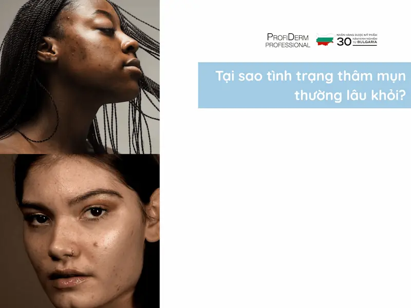 hết thâm mụn trong 1 tuần