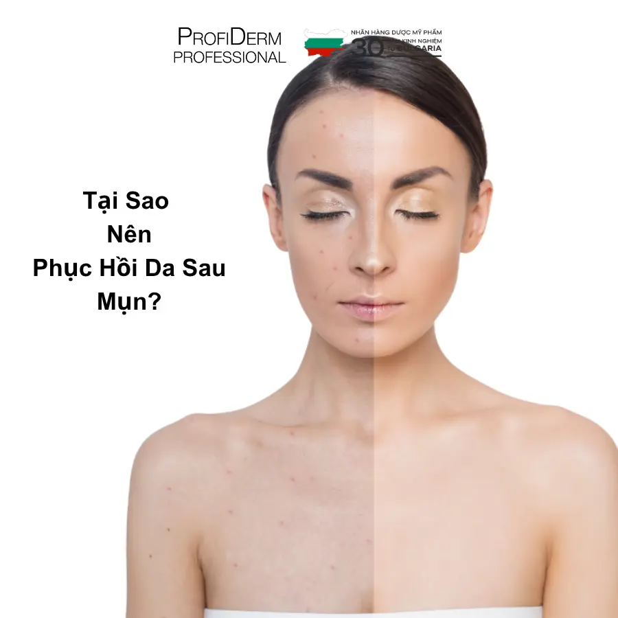phục hồi da mụn