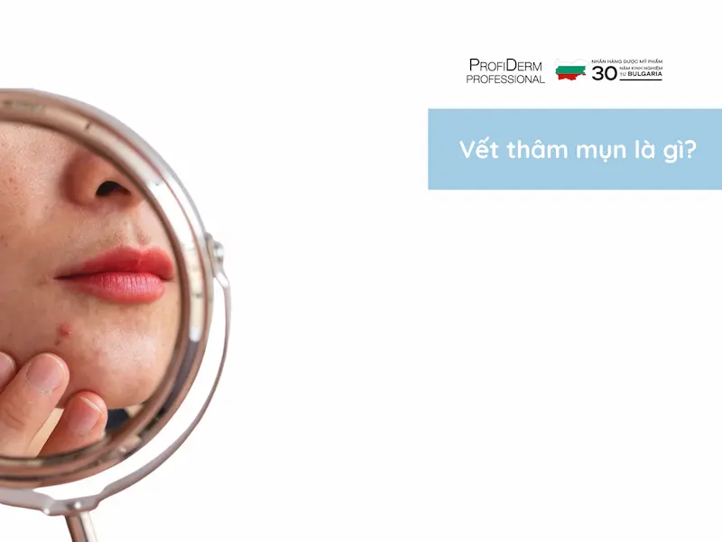 vết thâm mụn mãi không hết