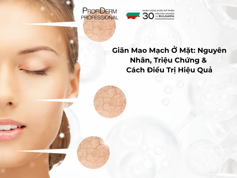 giãn mao mạch mặt giãn mao mạch mặt