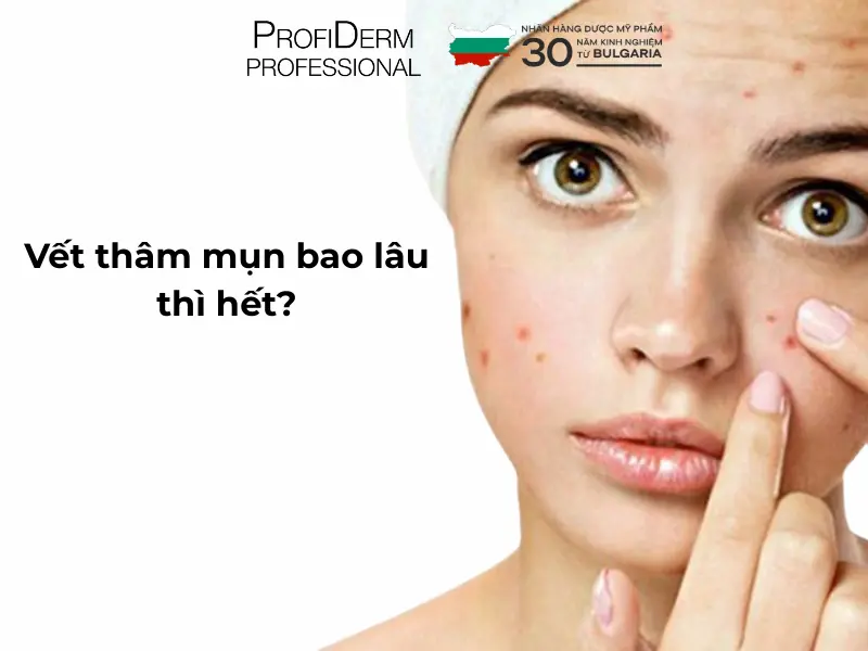 Vết thâm mụn bao lâu thì hết?