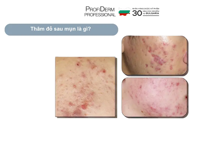 thâm đỏ sau mụn có tự hết không thâm đỏ sau mụn có tự hết không