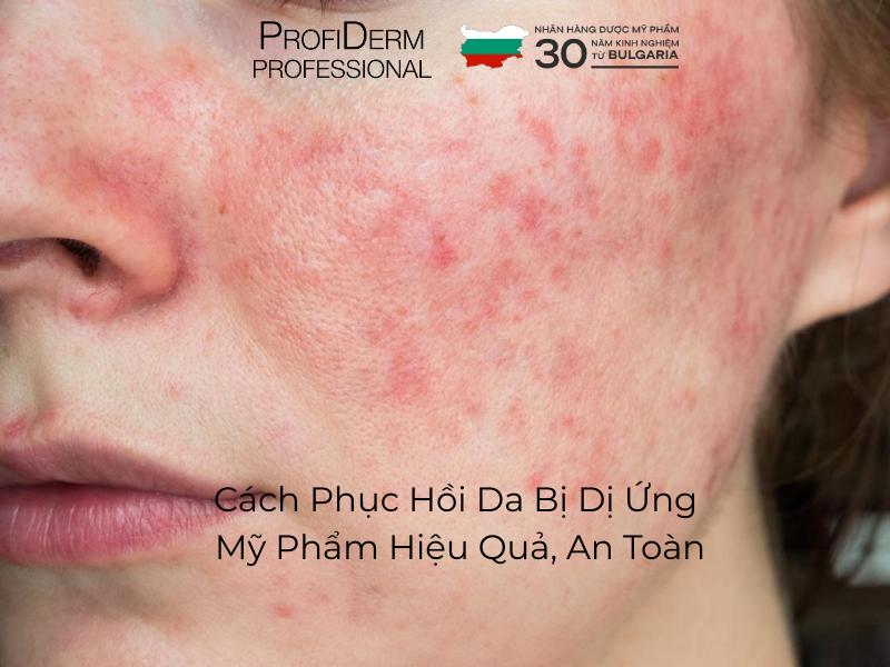 Cách Phục Hồi Da Bị Dị Ứng Mỹ Phẩm Hiệu Quả, An Toàn