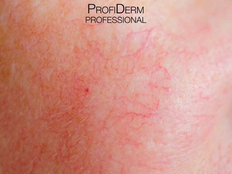 trị da mặt mỏng nổi gân máu tại nhà