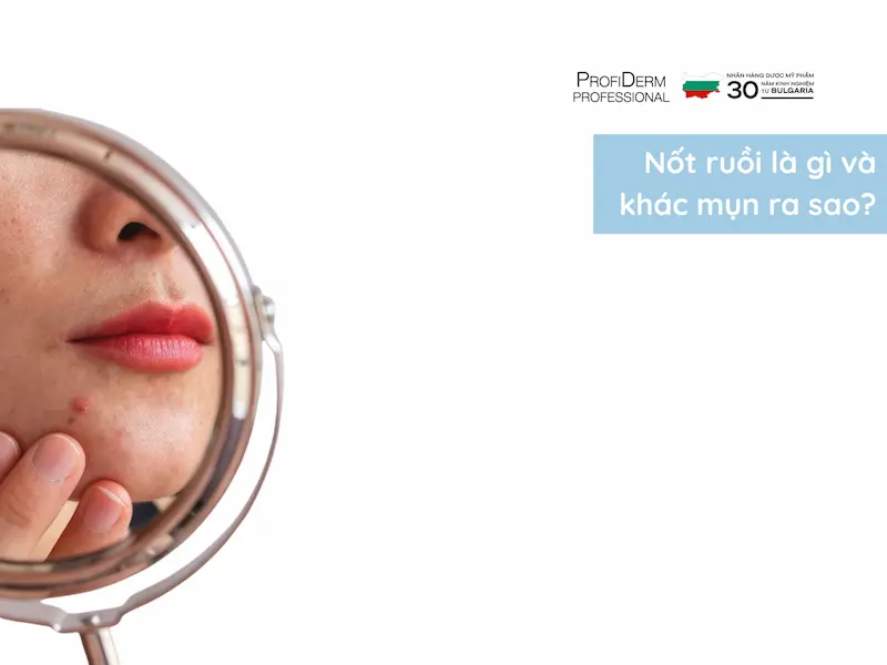 mụn để lâu không nặn có thành nốt ruồi không